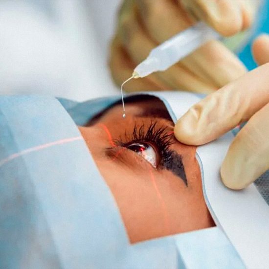 É preciso anestesia geral para cirurgia nos olhos?
