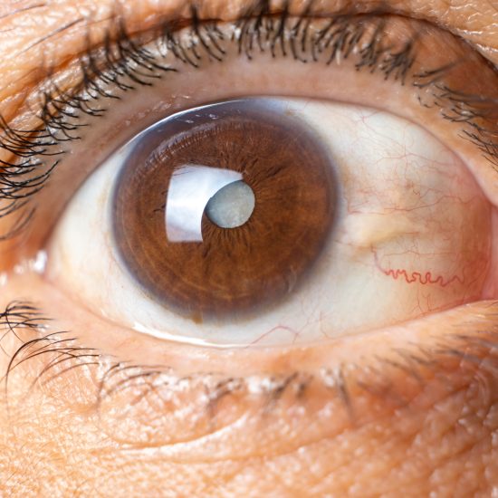 Catarata – Lentes Intraoculares