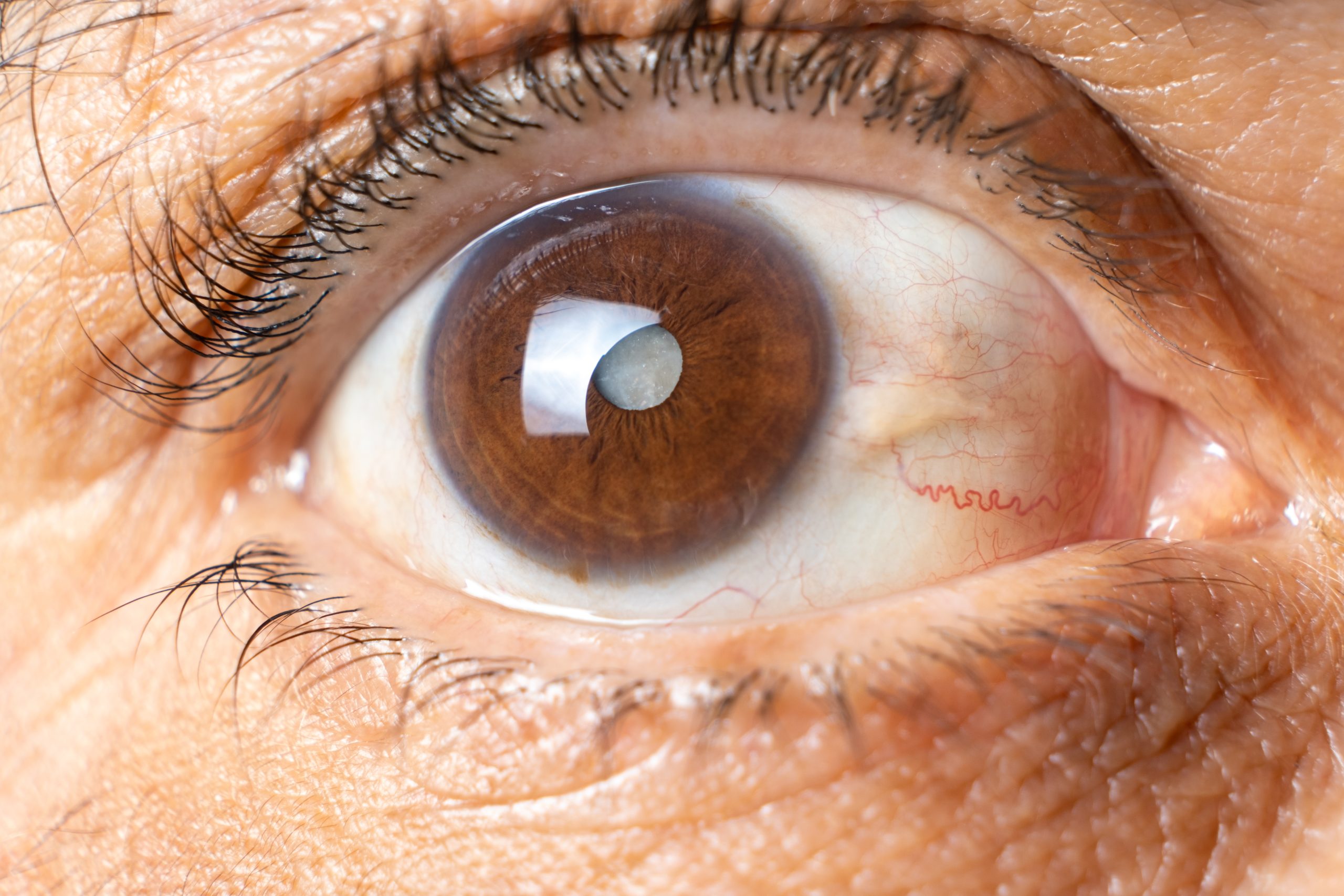 Catarata – Lentes Intraoculares