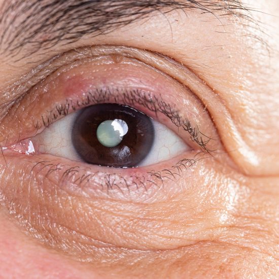 Catarata e Glaucoma