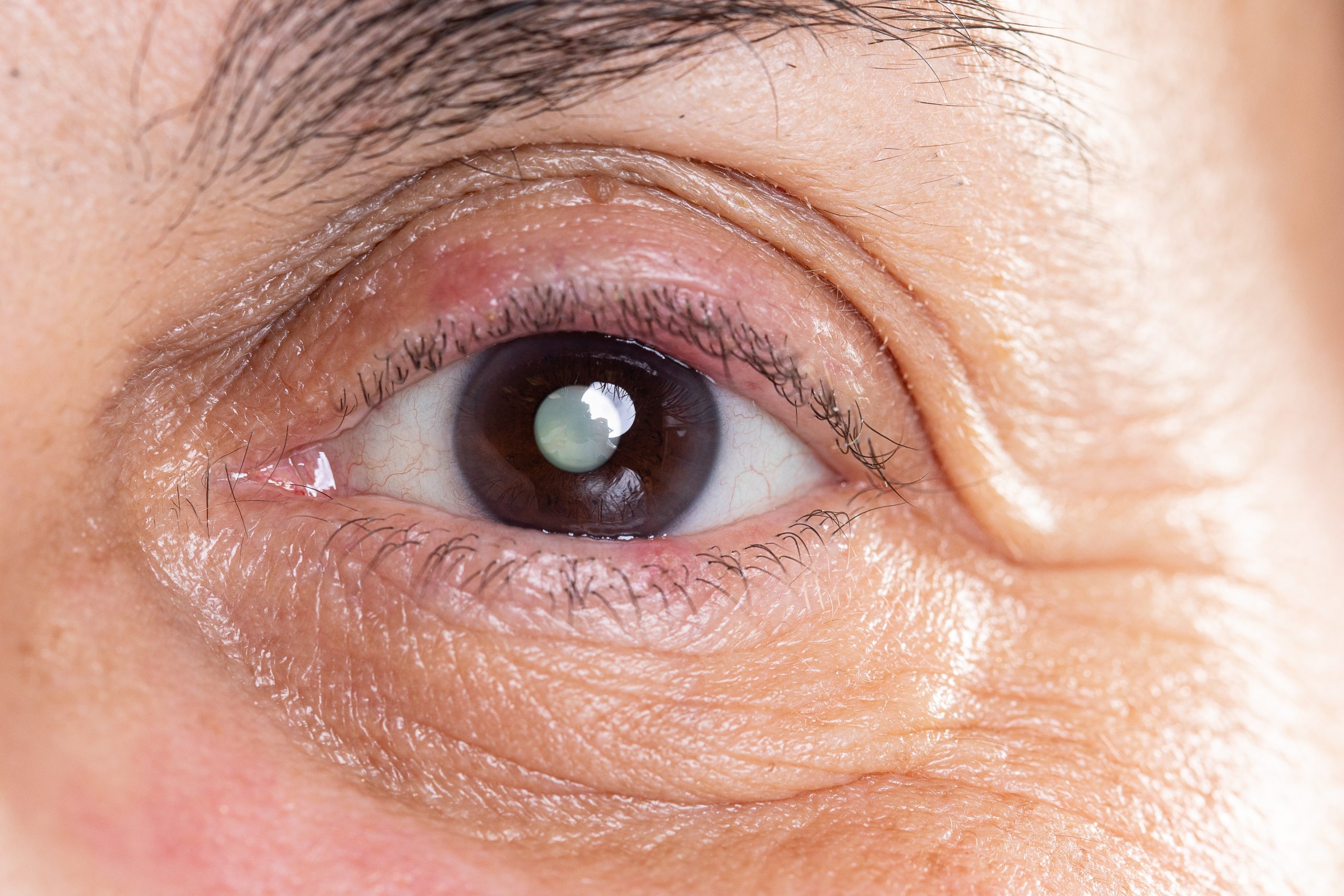 Catarata e Glaucoma