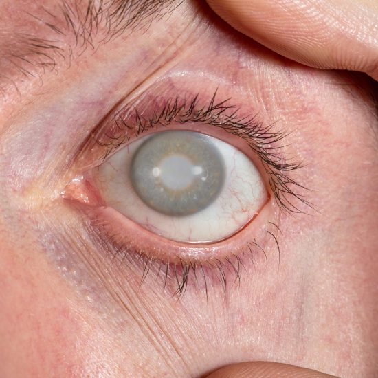 Glaucoma na Família
