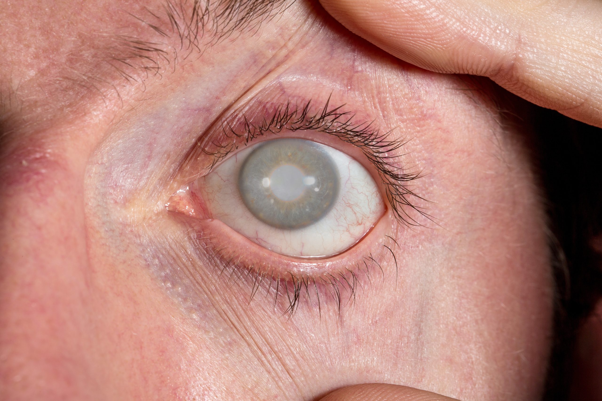 Glaucoma na Família