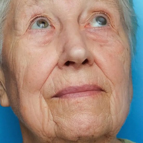Catarata: 7 sinais de que está na hora de procurar um oftalmologista