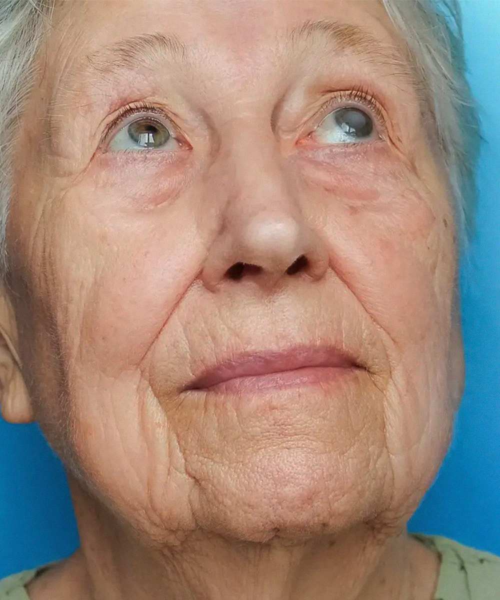 Catarata: 7 sinais de que está na hora de procurar um oftalmologista